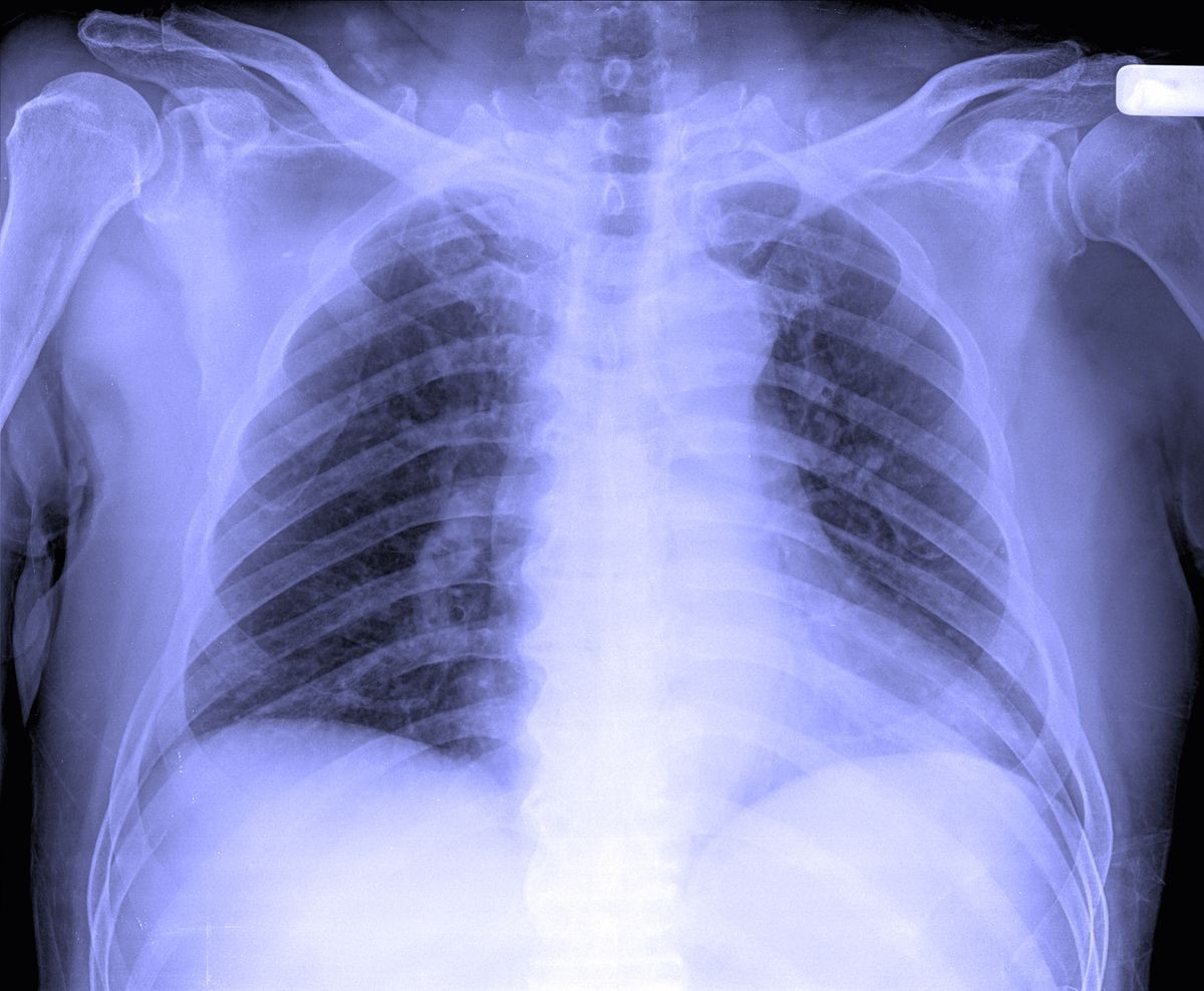 X-Ray image of male human chest for TB screening